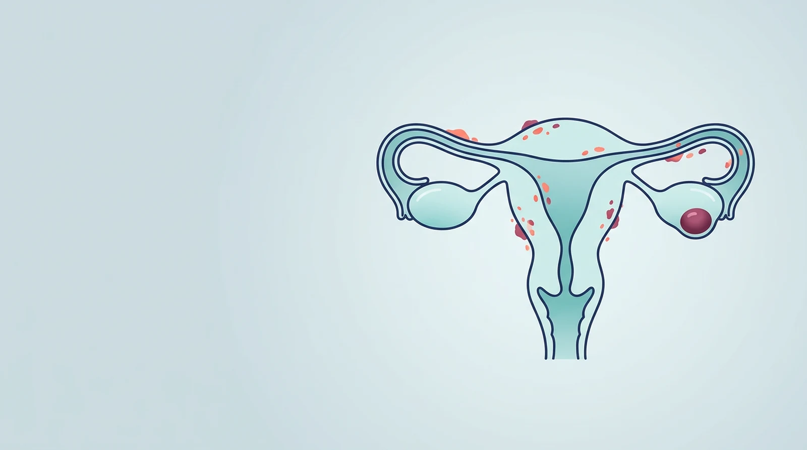 Ilustración del útero, las trompas y los ovarios con lesiones de endometriosis fuera del útero y un endometrioma en un ovario
